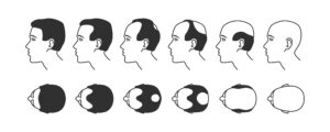 Male pattern baldness stages Medicalmojo.co.uk