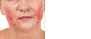 Rosacea photo Medicalmojo.co.uk