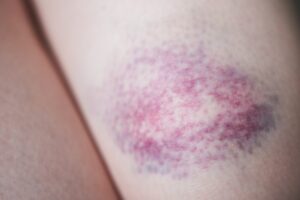 A close up of a bruise. Medicalmojo.co.uk